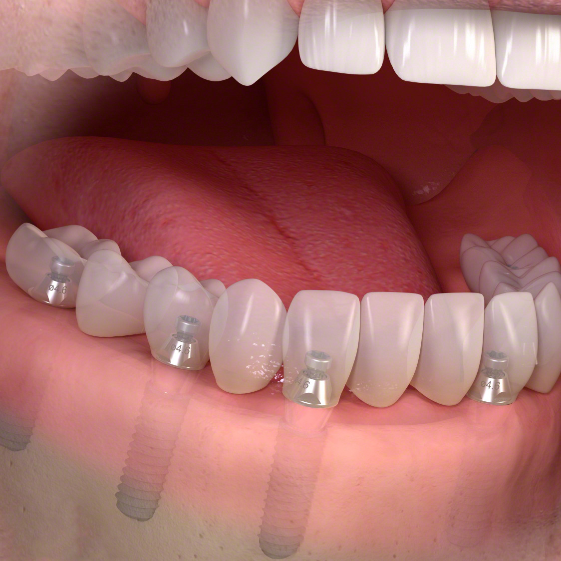 Ersatz aller Zähne mit einer auf mehreren Implantaten verankerten, nicht herausnehmbaren Brücke